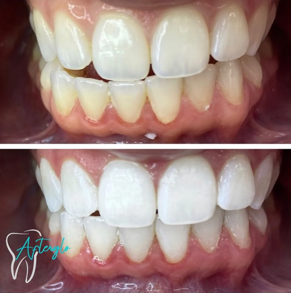Afterglo Organic Teeth Whitening Studio