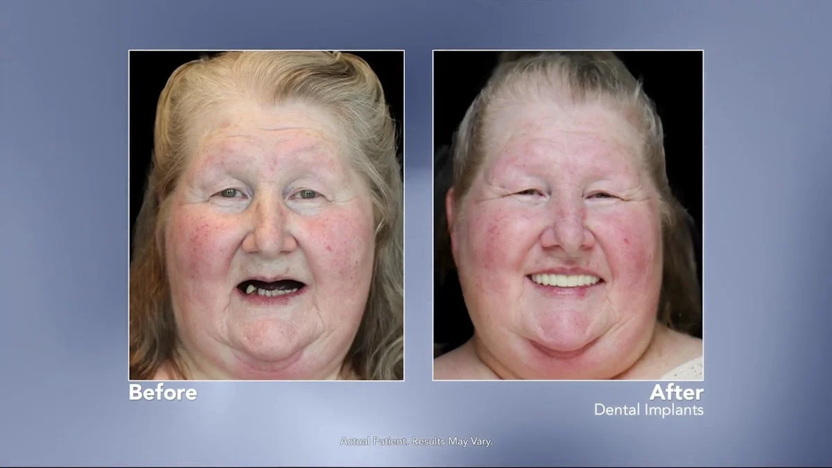 Smile Now Colorado Springs Dentures and Implants - 2