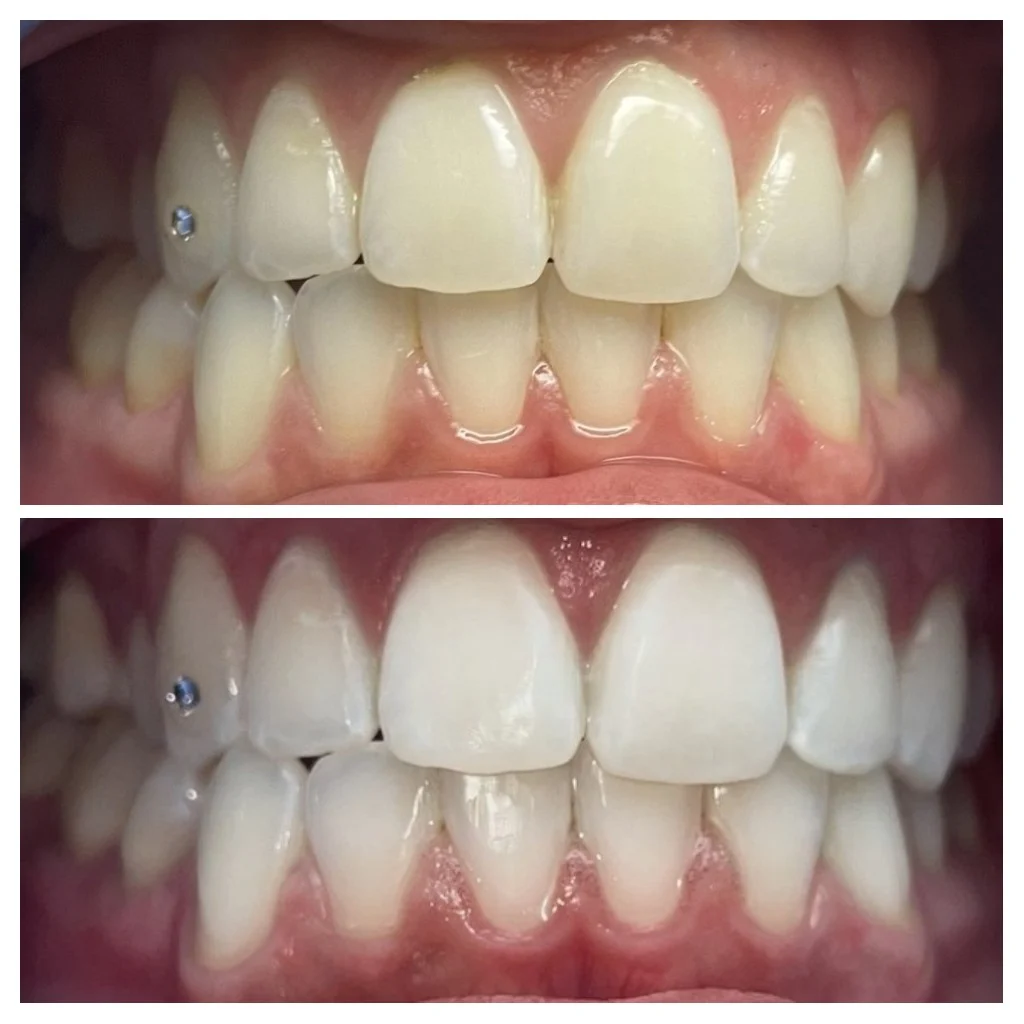 Yevonne’s Elite Teeth Whitening LLC (DaVinci)
